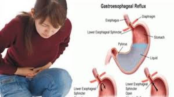 Cara Alami Turunkan Asam Lambung & GERD tanpa Obat